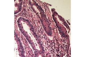 Immunohistochemical analysis of B4GALT2 staining in human colon cancer formalin fixed paraffin embedded tissue section. (B4GALT2 antibody  (C-Term))