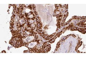 ABIN6267216 at 1/100 staining Human thyroid cancer tissue by IHC-P. (WIPI2 antibody  (C-Term))