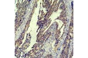 Immunohistochemical analysis of c-Jun staining in human breast cancer formalin fixed paraffin embedded tissue section. (C-JUN antibody)