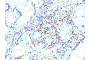 Formalin-fixed, paraffin-embedded human angiosarcoma stained with SMMHC antibody (MYH11/923 + SMMS-1).