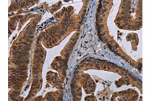 The image on the left is immunohistochemistry of paraffin-embedded Human gastric cancer tissue using ABIN7191352(MAGEB3 Antibody) at dilution 1/20, on the right is treated with synthetic peptide. (MAGEB3 antibody)