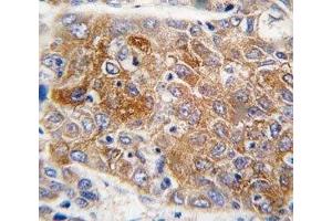 IHC analysis of FFPE human hepatocarcinoma tissue stained with ALDH1L1 antibody (ALDH1L1 antibody  (AA 717-746))