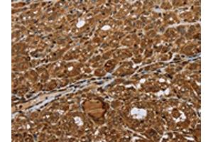 The image on the left is immunohistochemistry of paraffin-embedded Human thyroid cancer tissue using ABIN7192693(STMN2/STMN3/STMN4 Antibody) at dilution 1/45, on the right is treated with synthetic peptide. (STMN2/STMN3/STMN4 antibody)