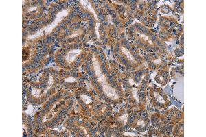 Immunohistochemistry of Human colon cancer using TLR8 Polyclonal Antibody at dilution of 1:40 (TLR8 antibody)