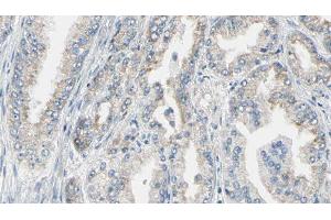 ABIN6276720 at 1/100 staining Human prostate tissue by IHC-P. (Phenylalanine Hydroxylase antibody  (N-Term))