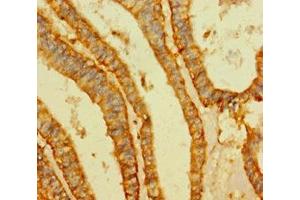 Immunohistochemistry of paraffin-embedded human endometrial cancer using ABIN7175511 at dilution of 1:100 (Vimentin antibody  (AA 2-466))