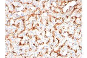 Formalin-fixed, paraffin-embedded human Hepatocellular Carcinoma stained with C1QB Mouse Monoclonal Antibody (C1QB/2965). (C1QB antibody  (AA 41-188))