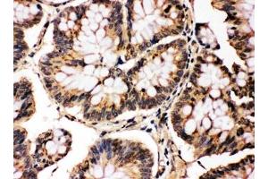 IHC testing of FFPE human intestinal cancer with MAPK8/9 antibody. (MAPK8 / MAPK9 (Middle Region) antibody)