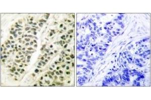 Immunohistochemistry analysis of paraffin-embedded human breast carcinoma tissue, using DNA Polymerase beta Antibody. (POLB antibody  (AA 286-335))