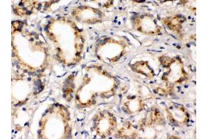 Anti- FXYZ1 Picoband antibody, IHC(P) IHC(P): Human Prostatic Cancer Tissue