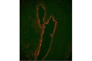 Immunofluorescence analysis of LTF Monoclonal Antibody with paraffin-embedded human prostate carcinoma tissue. (Lactoferrin antibody)