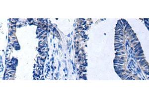 Immunohistochemistry of paraffin-embedded Human prost at e cancer tissue using PROC Polyclonal Antibody at dilution of 1:80(x200) (PROC antibody)