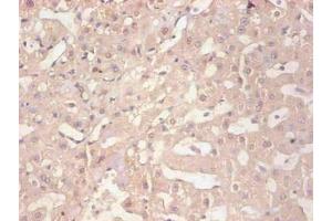 Immunohistochemical of paraffin-embedded human liver tissue using ABIN7152718 at dilution of 1:200 (FTL antibody)