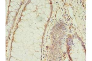 Immunohistochemistry of paraffin-embedded human colon cancer using ABIN7159399 at dilution of 1:100 (MS4A7 antibody  (AA 1-47))