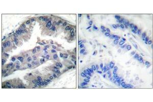 Immunohistochemical analysis of paraffin-embedded human lung carcinoma tissue, using BIK (Phospho-Thr33) antibody. (BIK antibody  (pThr33))