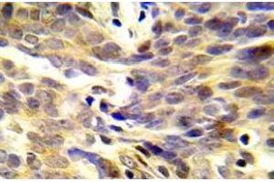 Immunohistochemistry (IHC) analyzes of p-BRCA1 antibody in paraffin-embedded human lung adenocarcinoma tissue. (BRCA1 antibody  (pSer1423))