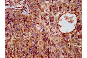 IHC image of ABIN7163983 diluted at 1:200 and staining in paraffin-embedded human cervical cancer performed on a Leica BondTM system. (Kcne3 antibody  (AA 1-57))