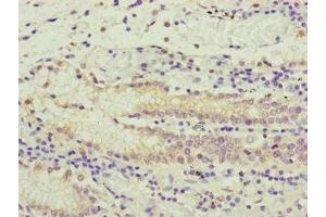 Immunohistochemistry of paraffin-embedded human gastric cancer using ABIN7166519 at dilution of 1:100 (PCDHA12 antibody  (AA 862-941))