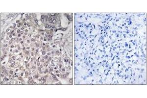 Immunohistochemistry analysis of paraffin-embedded human liver carcinoma, using Cytochrome P450 4F2 Antibody. (CYP4F2 antibody  (AA 41-90))