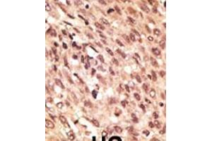 Formalin-fixed and paraffin-embedded human cancer tissue reacted with the primary antibody, which was peroxidase-conjugated to the secondary antibody, followed by AEC staining. (LRP5 antibody  (C-Term))