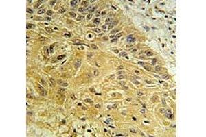WNT5A antibody immunohistochemistry analysis in formalin fixed and paraffin embedded human lung carcinoma. (WNT5A antibody  (AA 185-213))