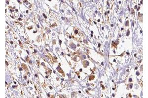 ABIN6279776 at 1/100 staining Human breast cancer tissue by IHC-P.
