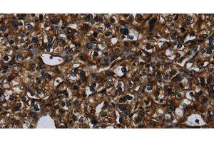 Immunohistochemistry of paraffin-embedded Human prostate cancer using KLK14 Polyclonal Antibody at dilution of 1:40 (Kallikrein 14 antibody)