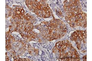 Immunoperoxidase of monoclonal antibody to EIF4G3 on formalin-fixed paraffin-embedded human lung, adenosquamous cell carcinoma. (EIF4G3 antibody  (AA 1-515))