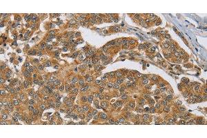 Immunohistochemistry of paraffin-embedded Human breast cancer tissue using ERK 3 Polyclonal Antibody at dilution 1:40 (MAPK6 antibody)
