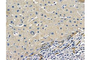 ABIN7096957 and ABIN7101024 at 1/100 staining human liver cancer by IHC-P.