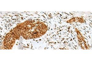 Immunohistochemistry of paraffin-embedded Human esophagus cancer tissue using HMG20A Polyclonal Antibody at dilution of 1:25(x200) (HMG20A antibody)