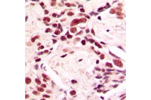 Immunohistochemical analysis of Lamin A/C staining in human breast cancer formalin fixed paraffin embedded tissue section.