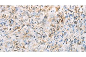 Immunohistochemistry of paraffin-embedded Human gasrtic cancer tissue using NPPC Polyclonal Antibody at dilution 1:70 (NPPC antibody)