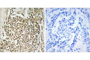 Peptide - +Immunohistochemistry analysis of paraffin-embedded human breast carcinoma tissue using CEP350 antibody. (CEP350 antibody)