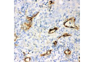 Anti- CD146 antibody, IHC(P) IHC(P): Human Lung Cancer Tissue (MCAM antibody  (AA 59-401))