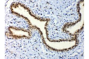 IHC analysis of ETV6/Tel using anti-ETV6/Tel antibody . (ETV6 antibody  (AA 327-448))