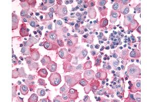 Anti-OR10J5 antibody IHC of human Skin, Melanoma. (OR10J5 antibody  (Extracellular Domain))
