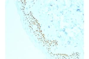 Formalin-fixed, paraffin-embedded human Basal Cell Carcinoma stained with p63 Mouse Monoclonal Antibody (TP63/2428). (p63 antibody)