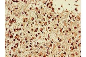 IHC image of ABIN7173856 diluted at 1:400 and staining in paraffin-embedded human glioma performed on a Leica BondTM system. (NGFR antibody  (AA 277-391))