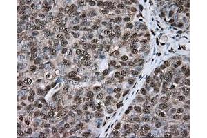 Immunohistochemical staining of paraffin-embedded colon tissue using anti-ERCC1 mouse monoclonal antibody. (ERCC1 antibody)