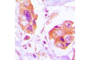 Immunohistochemical analysis of Filamin A (pS2152) staining in human lung cancer formalin fixed paraffin embedded tissue section.