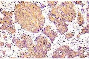 Immunohistochemistry (IHC) analyzes of p-COFILN1 (pSer3) antibody in paraffin-embedded human lung adenocarcinoma tissue. (Cofilin antibody  (pSer3))