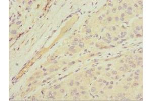 Immunohistochemistry of paraffin-embedded human liver cancer using ABIN7143763 at dilution of 1:100 (MGAT1 antibody  (AA 156-445))