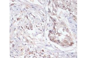 Immunohistochemistry of paraffin-embedded Human lung cancer using Phospho-Jak2(Y1007/1008) Polyclonal Antibody at dilution of 1:200 (40x lens). (JAK2 antibody  (pTyr1007, pTyr1008))
