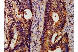 IHC image of ABIN7151663 diluted at 1:200 and staining in paraffin-embedded human colon cancer performed on a Leica BondTM system.