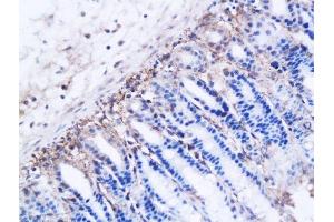 Formalin-fixed and paraffin embedded ovarian cancer xenograft labeled with Anti-DBC2 receptor Polyclonal Antibody, Unconjugated  followed by conjugation to the secondary antibody and DAB staining (RHOBTB2 antibody  (AA 631-727))