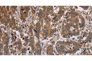 Immunohistochemistry of paraffin-embedded Human liver cancer tissue using FBP2 Polyclonal Antibody at dilution 1:40 (FBP2 antibody)