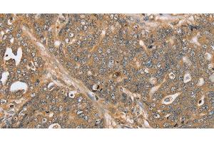 Immunohistochemistry of paraffin-embedded Human ovarian cancer using PTPN20 Polyclonal Antibody at dilution of 1:30
