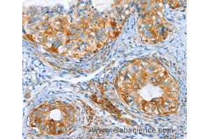 Immunohistochemistry of Human thyroid cancer using AIP Polyclonal Antibody at dilution of 1:80 (AIP antibody)