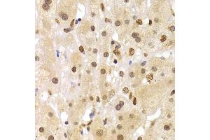 Immunohistochemistry of paraffin-embedded human liver cancer using HNRNPA1 Antibody (ABIN5975570) at dilution of 1/100 (40x lens). (HNRNPA1 antibody)